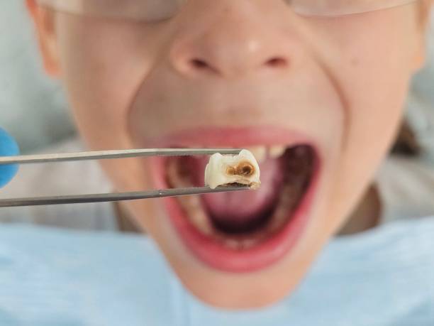 Best Emergency Dental Care for Abscessed Tooth in Napavine, WA